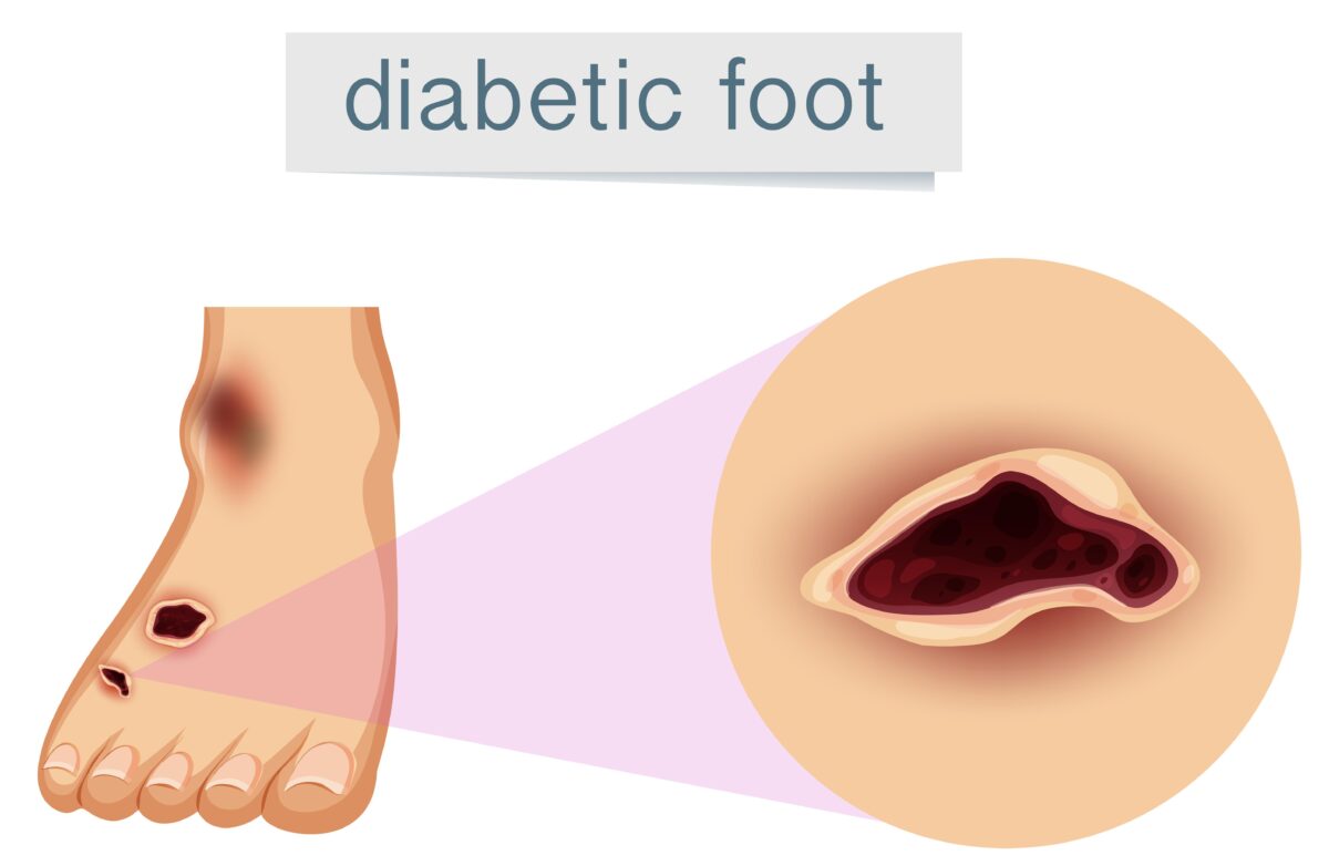 symptoms of diabetic foot